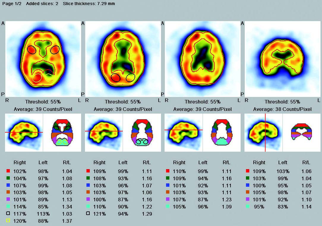 Brain Perfusion