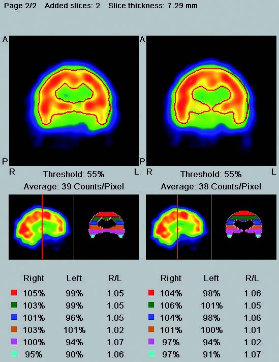slice analysis of the right and left side hemispheres