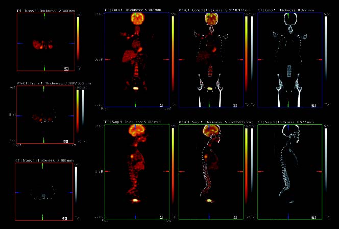SPECT : PET : CT 1