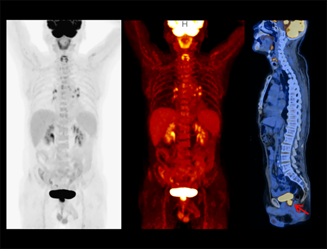 uMI 550_Rectal Cancer