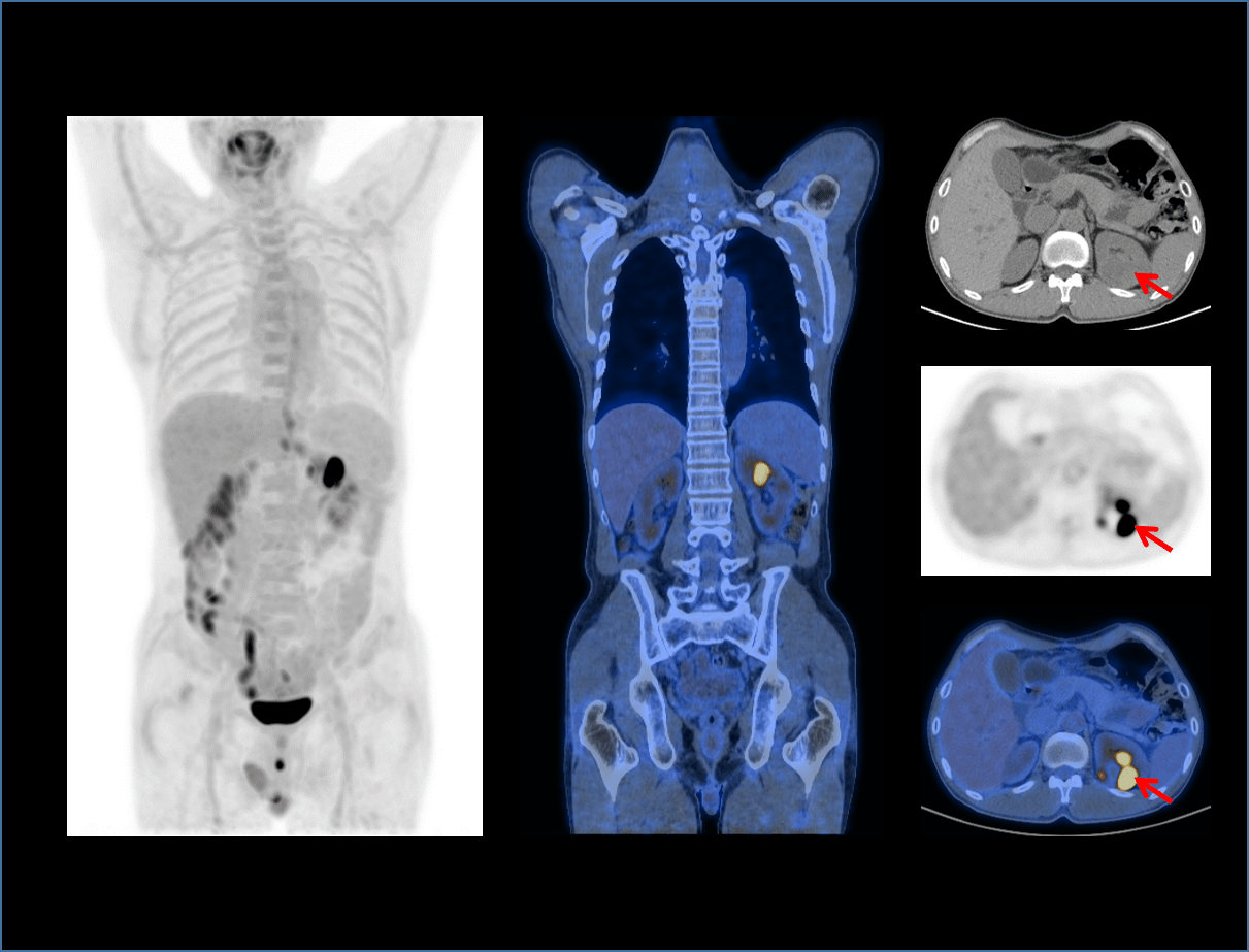 vista -Gastric lymphoma