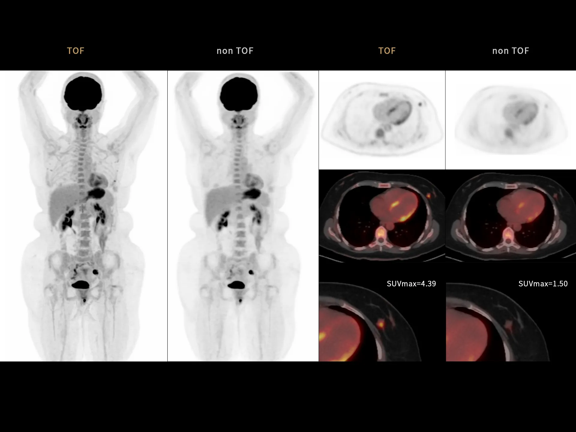 High TOF resolution of 219 ps enables better lesion detectability and quantitative accuracy