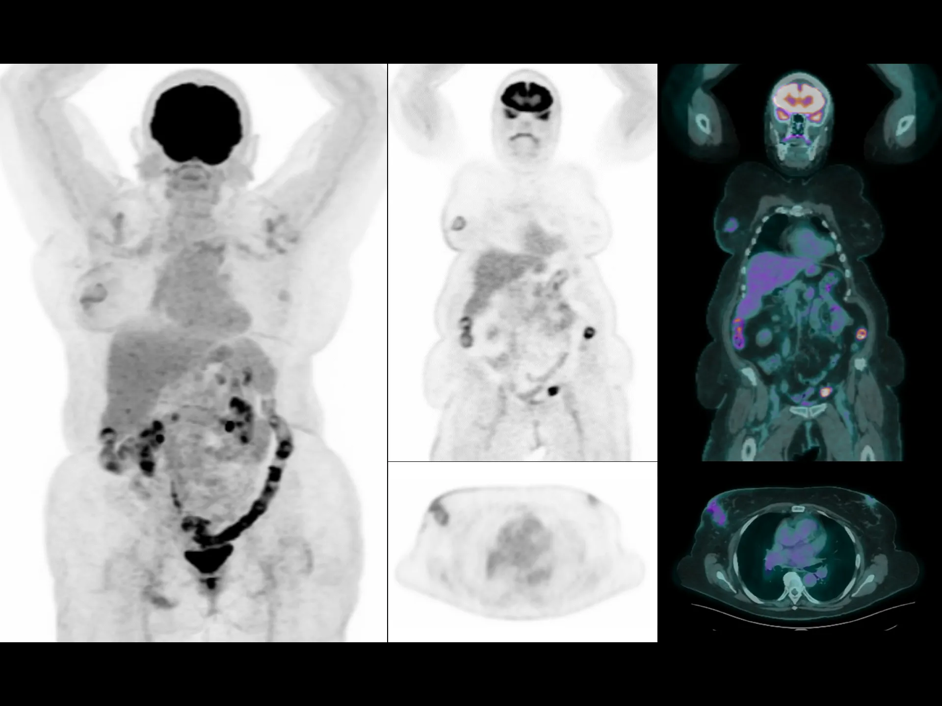 Low Dose Imaging of Large BMI Patient