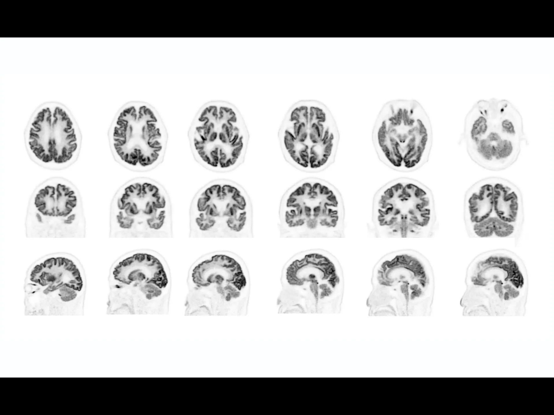 high resolution-image-of-F-FDG-brain-PET-CT-scan