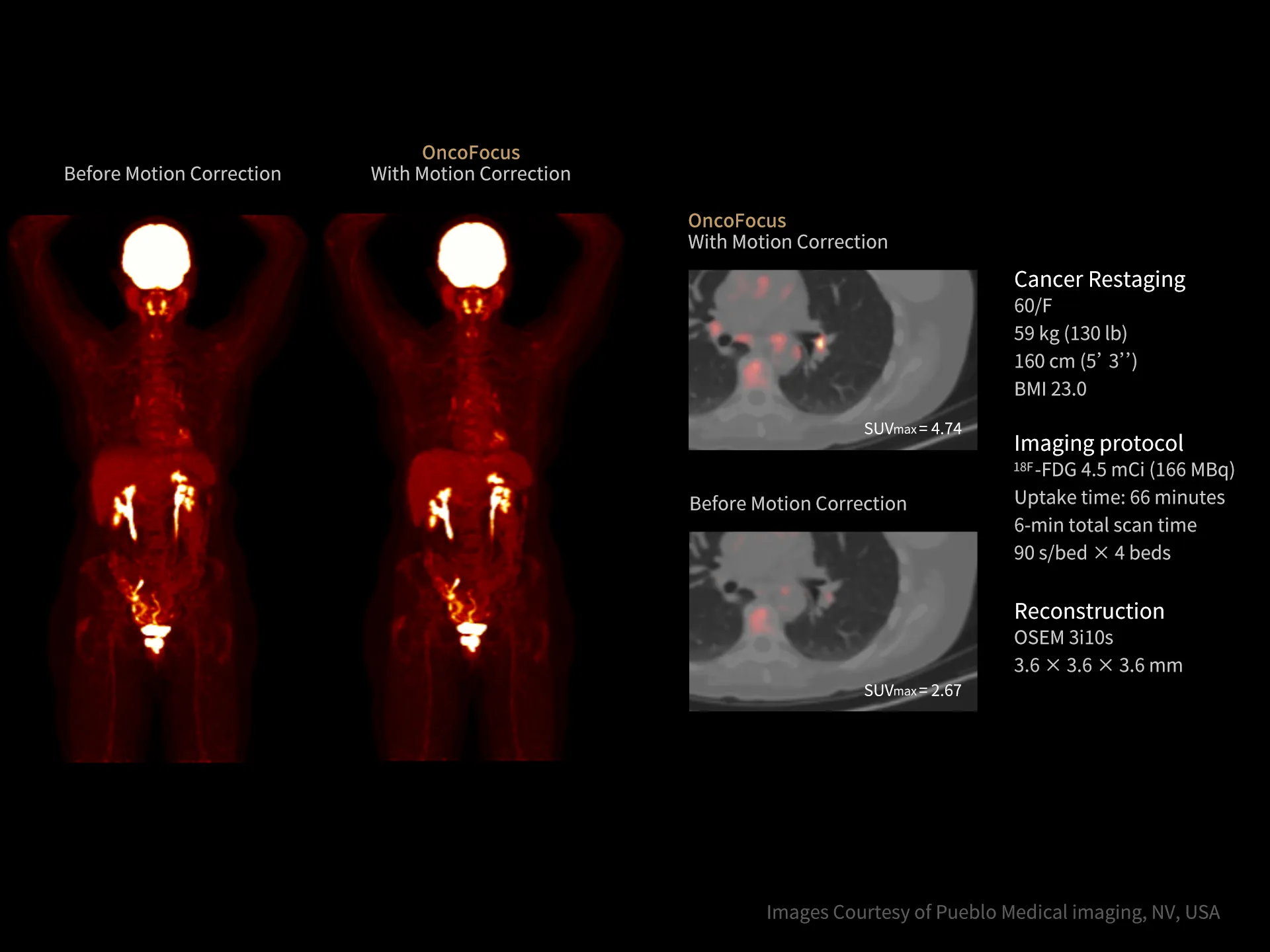 uExcel OncoFocus