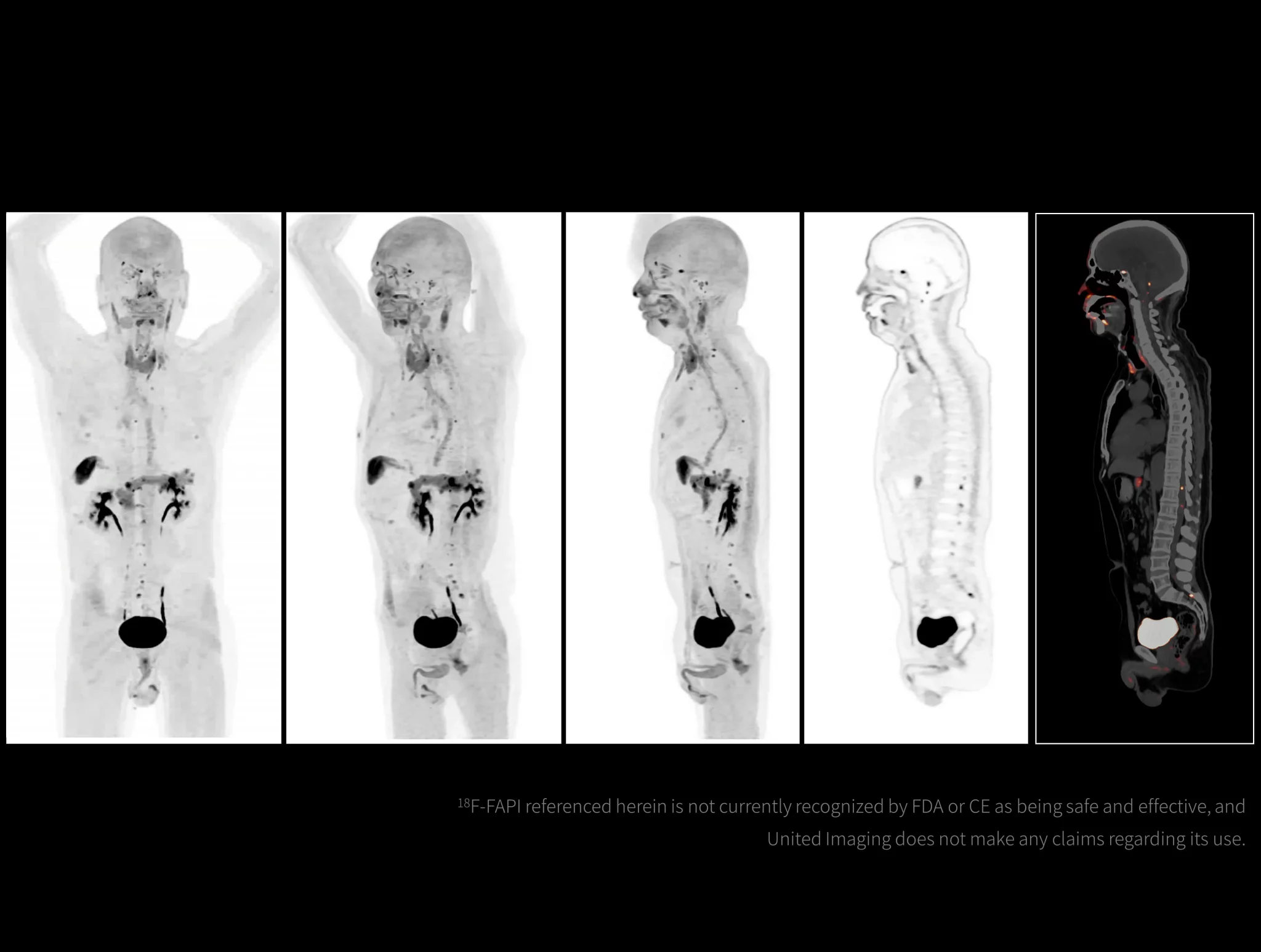 High-resolution imaging facilitates the visualization of leptomeningeal metastasis.