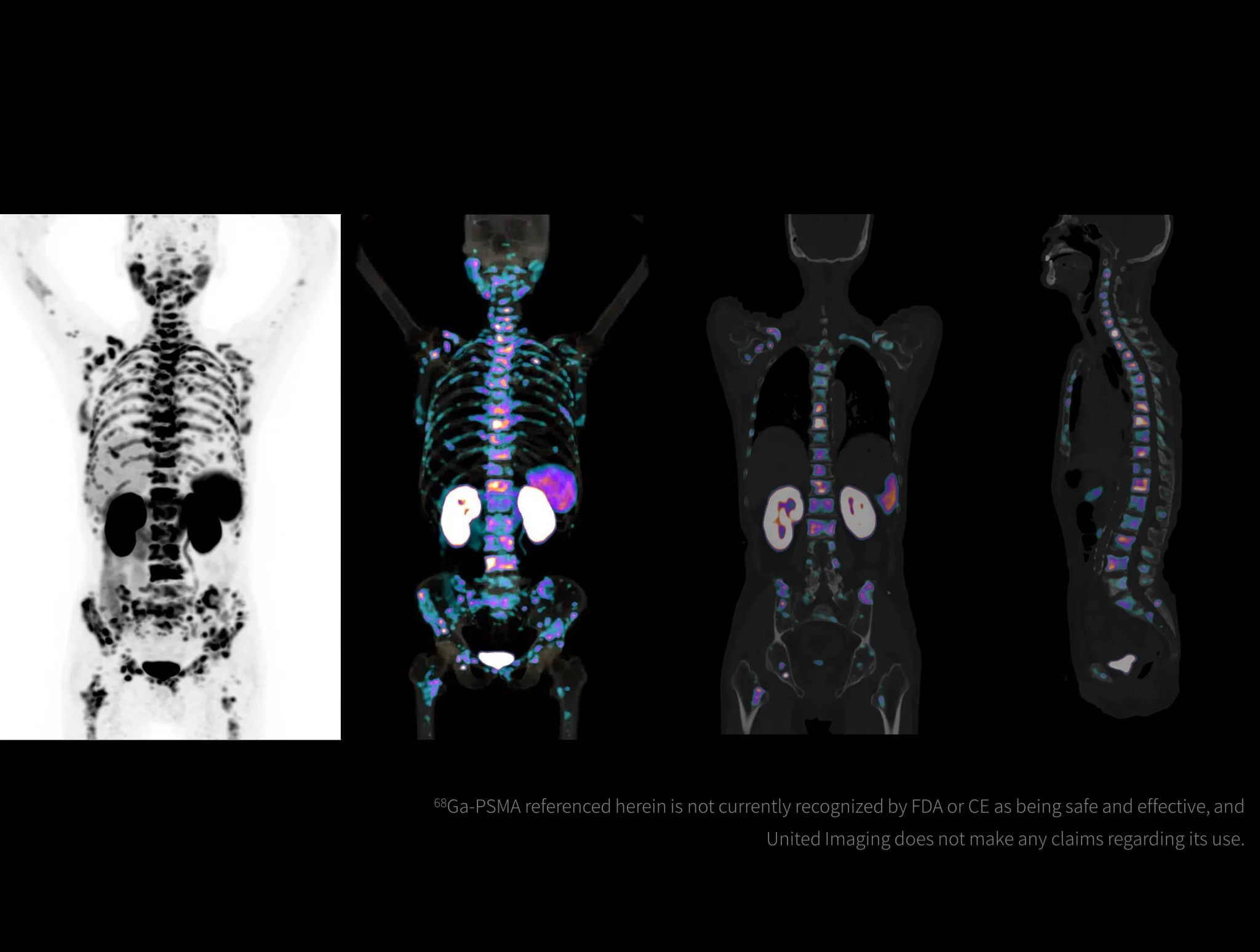 High-resolution imaging is enabled with a Gallium-labeled tracer in a low dose.