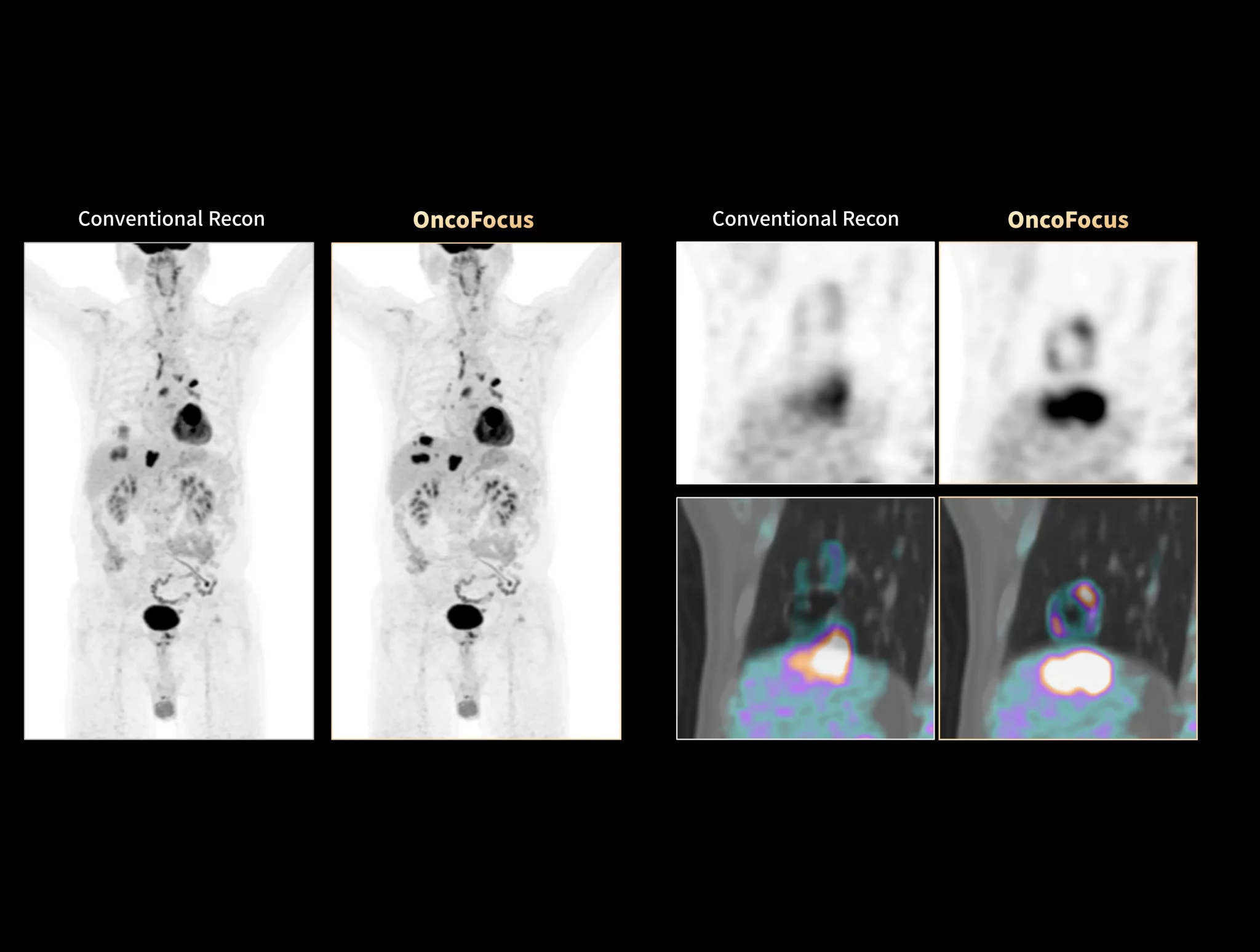Lung cancer with liver metastases hard to be seen can be clearly detected with OncoFocus.