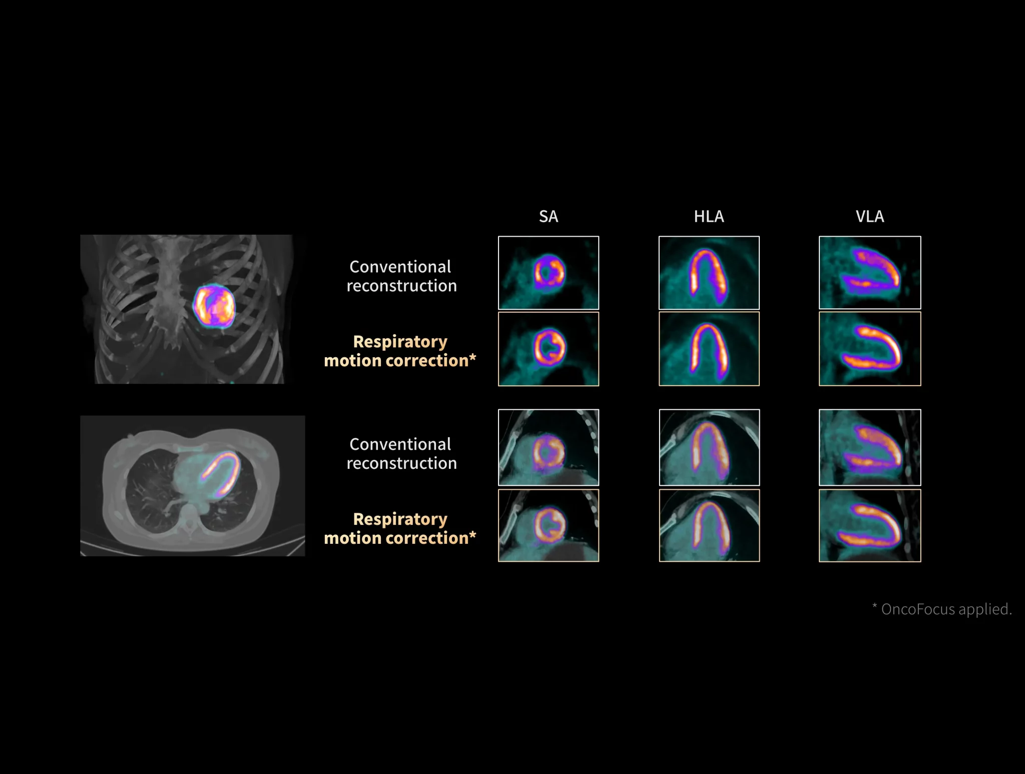 Myocardial morphology can be revealed with data-driven respiration motion correction.