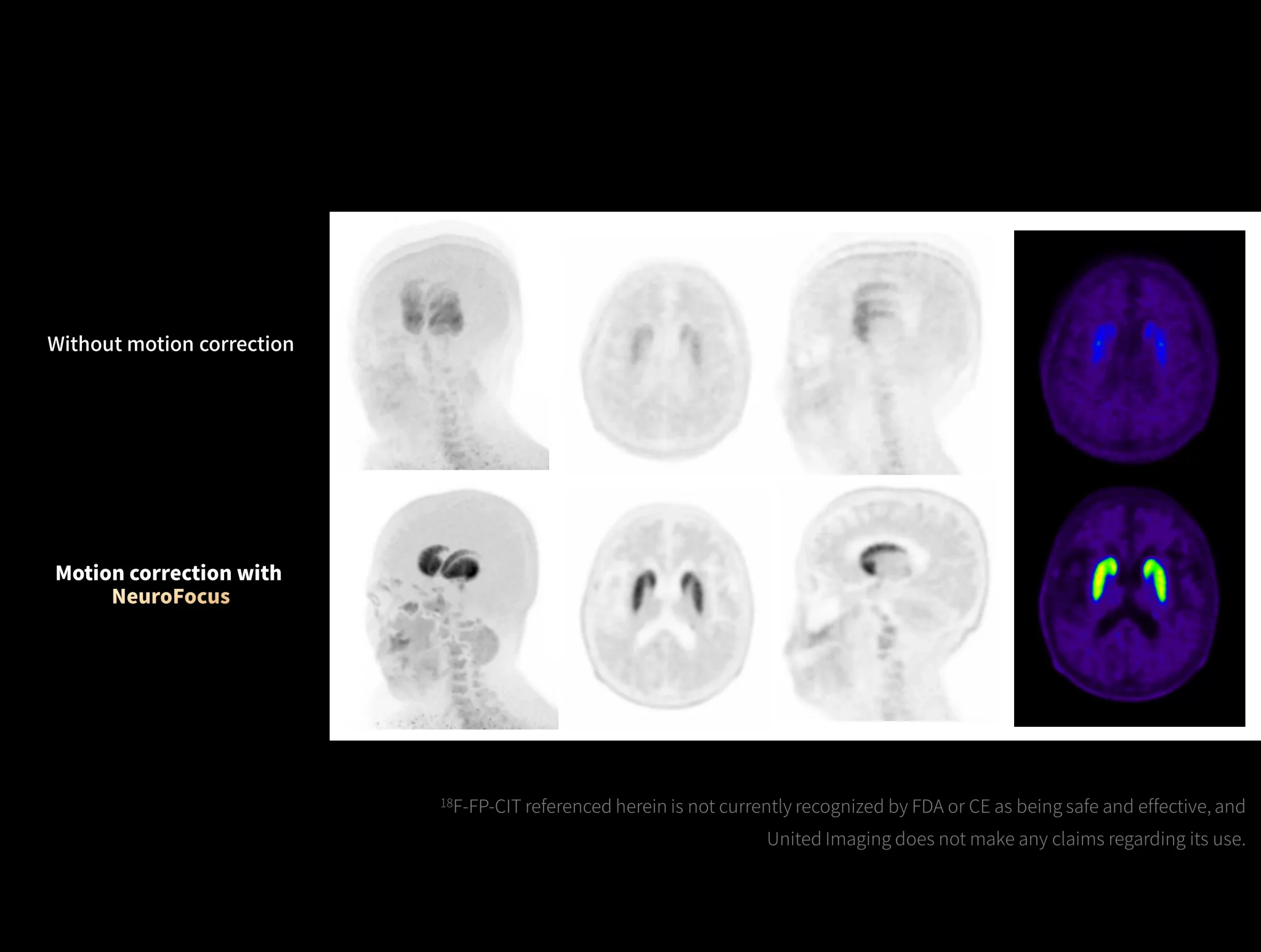 NeuroFocus corrects head motion artifacts in 18F-FP-CIT imaging.