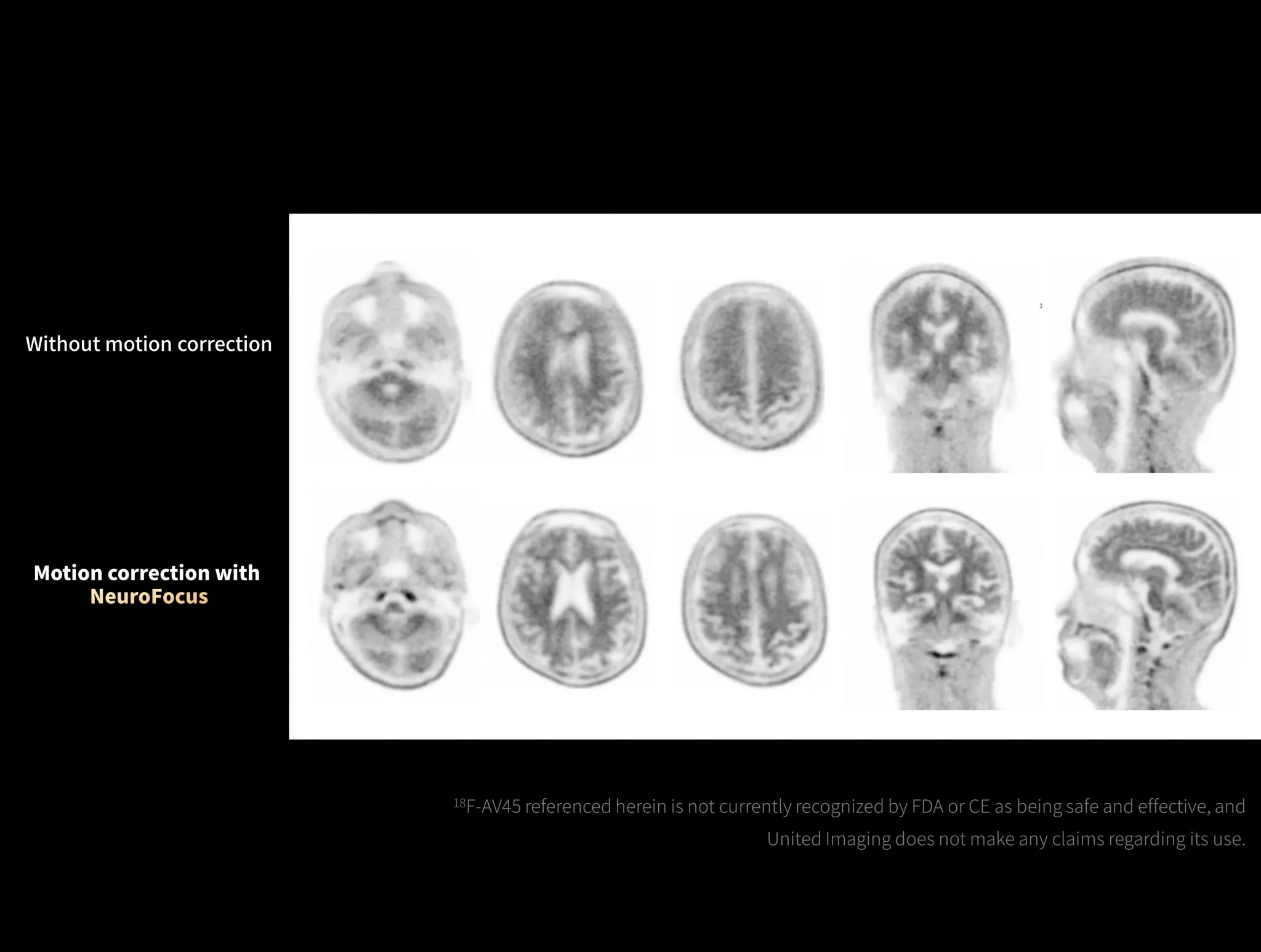 NeuroFocus mitigates head motion artifacts in 18F-AV45 imaging.
