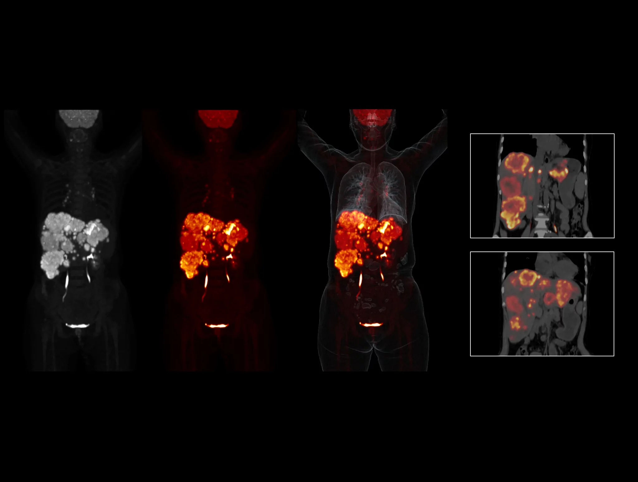 OncoFocus demonstrates clear demarcation of hepatic and gastric lesions.