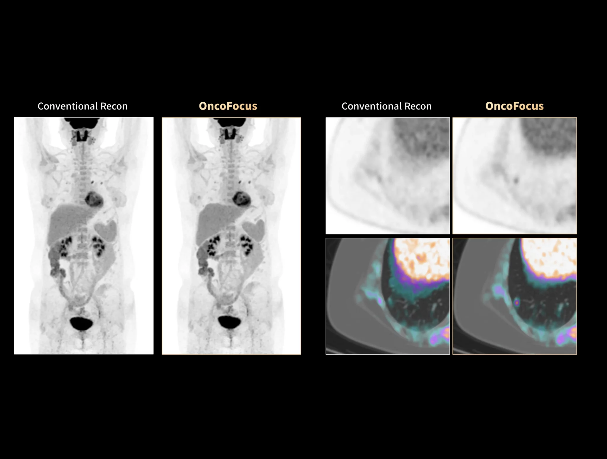 OncoFocus facilitates clear delineation of subcentimeter lower lung nodules.