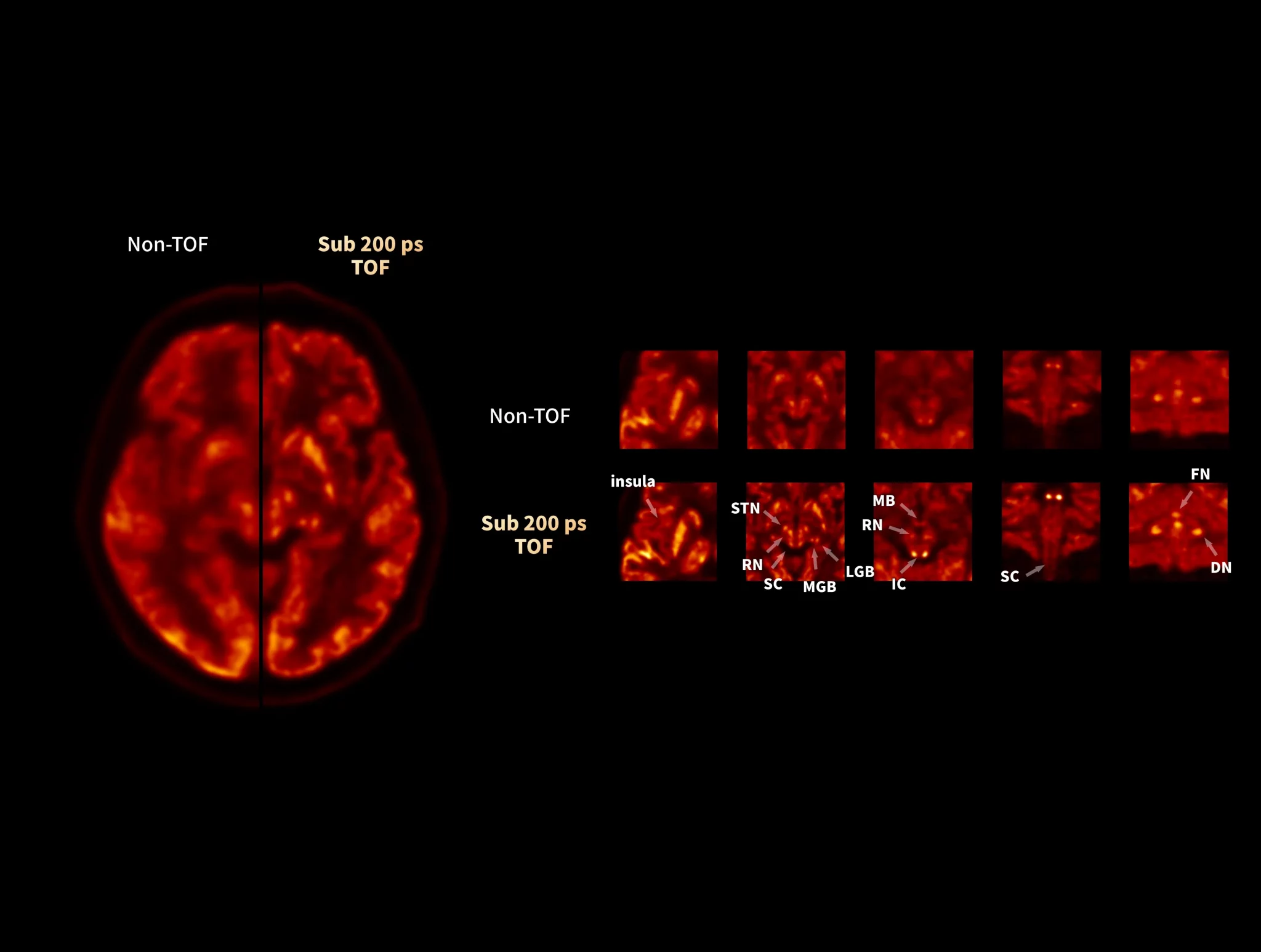 TOF performance enhances high-resolution brain PET imaging with combined anatomical and functional information.