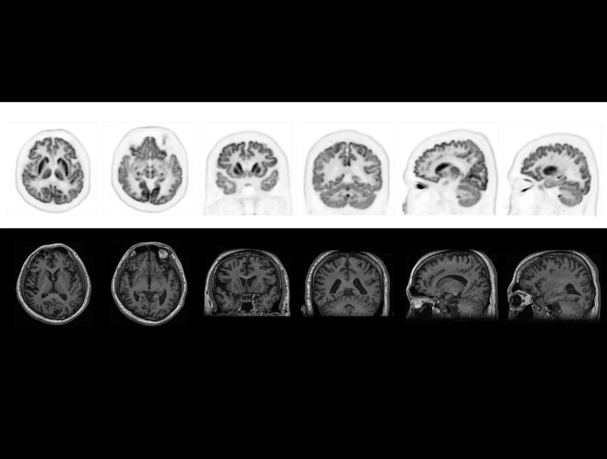 TOF technology renders high-definition gray and white matter imaging in Epileptic patients with MRI.