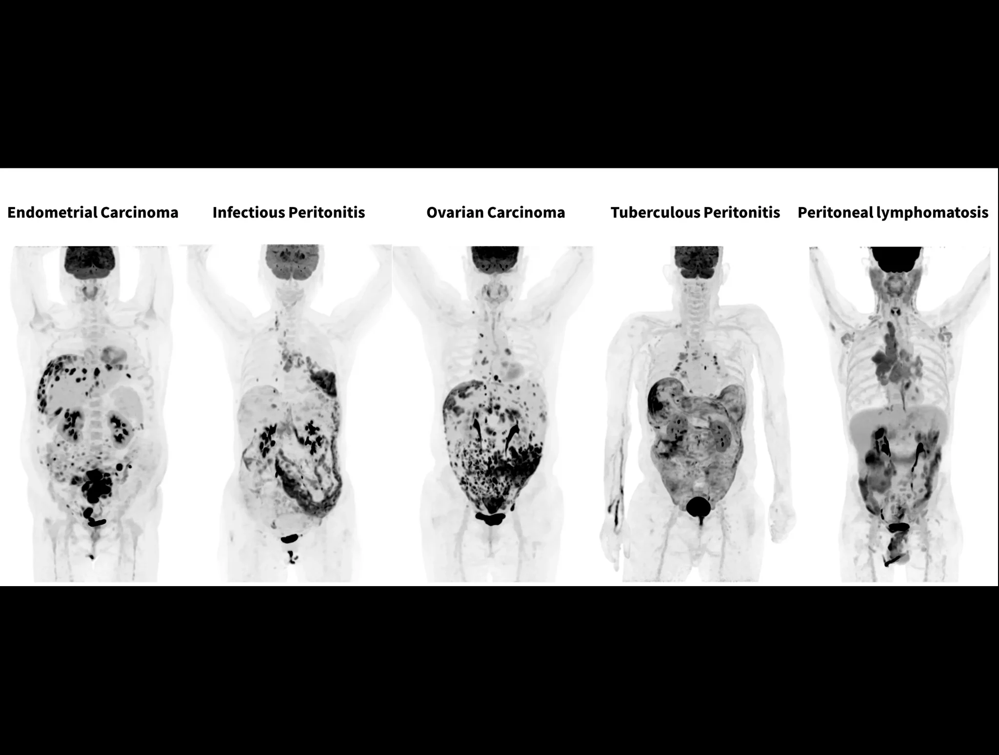 The high-resolution system with 189-ps TOF performance delivers exceptional image quality for peritoneal and omental diseases.