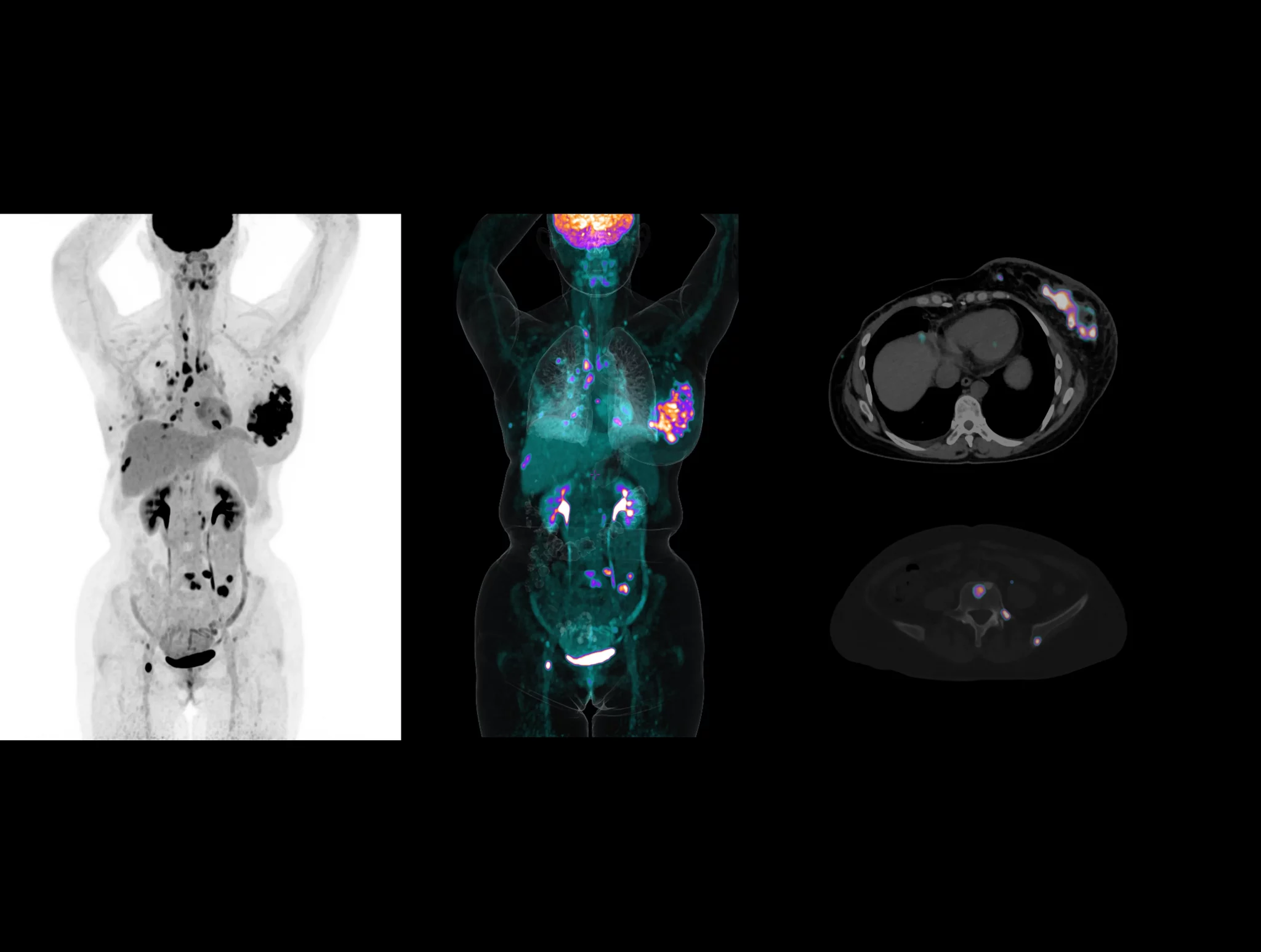The widespread metastasis of breast cancer can be clearly revealed by the high-resolution system with the super-fast time of flight.