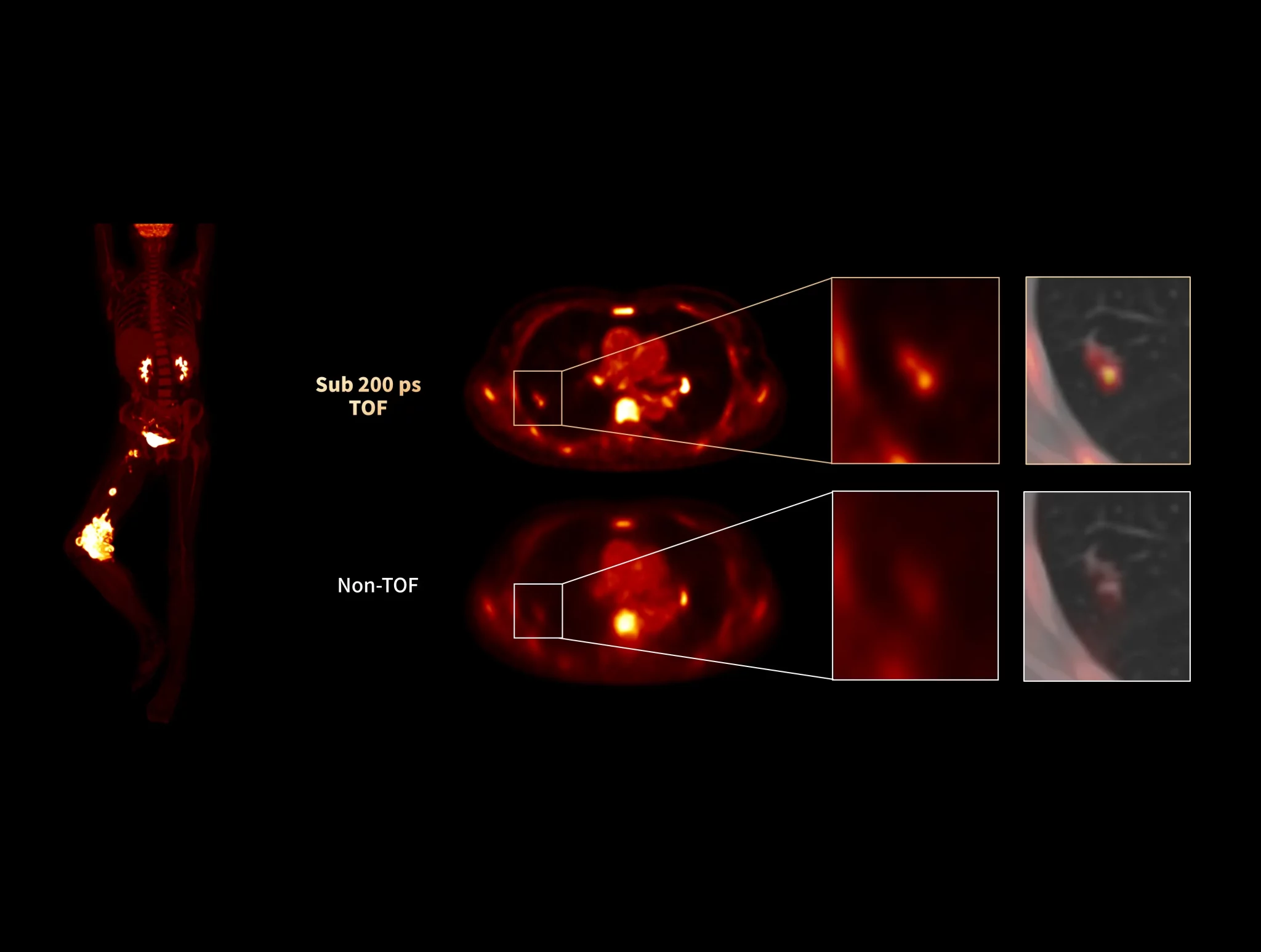 Time of flight technology enhances the high contrast visibility of small lung lesions.
