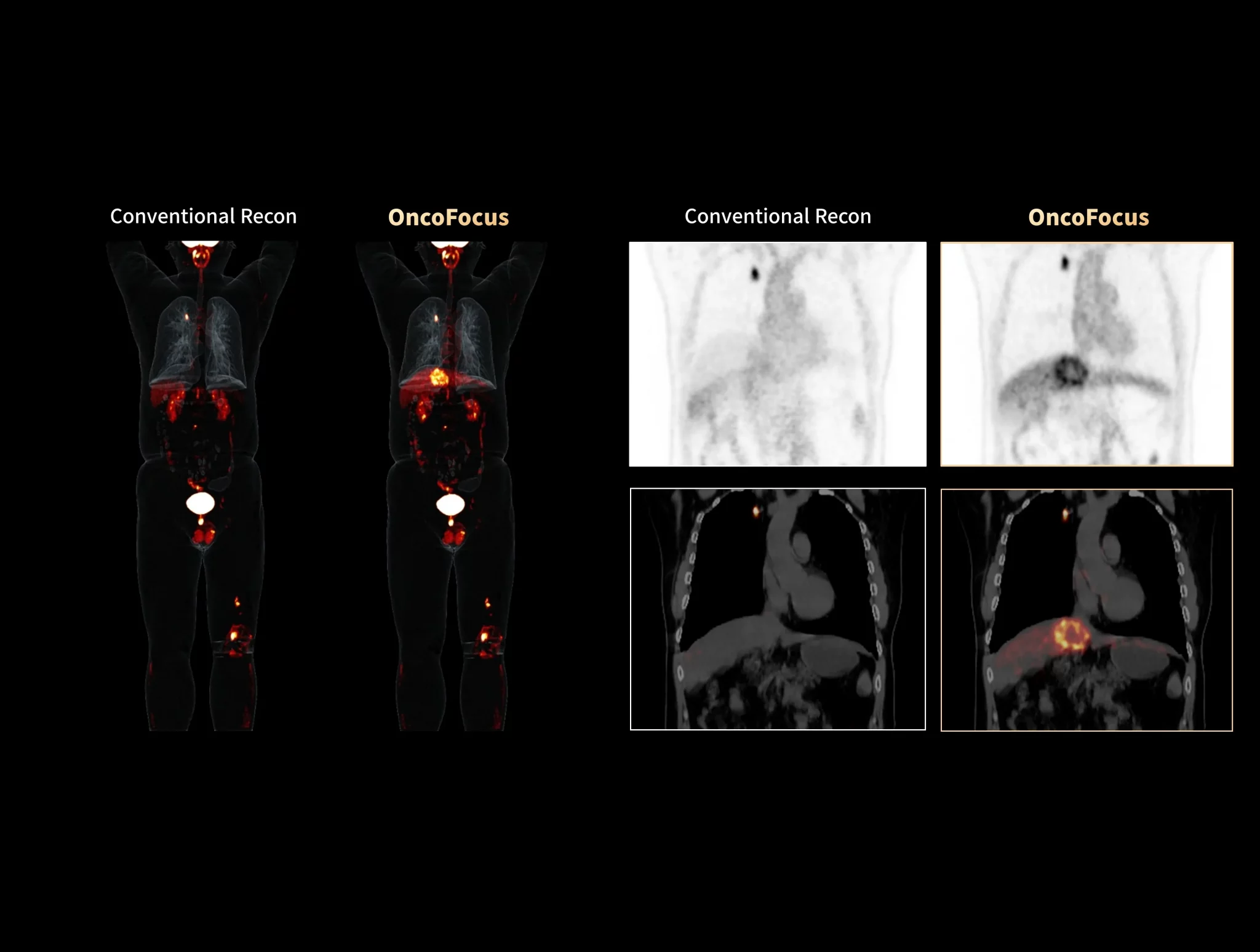 Unseen lesions of the osteosarcoma with liver and lung metastases can now be visualized with OncoFocus.