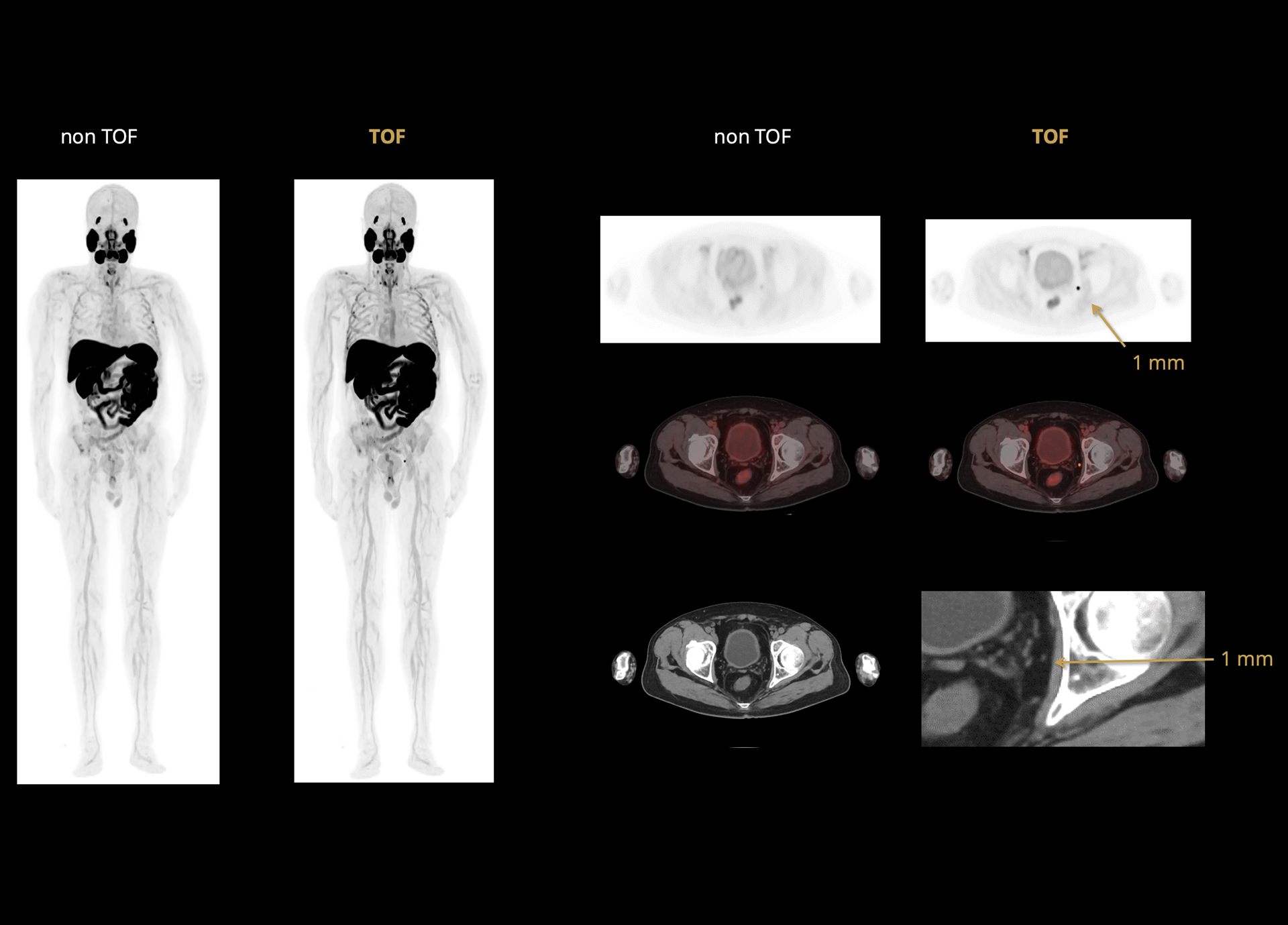 Improving Small Lesion Detectability and Delineation with 219 ps TOF Resolution