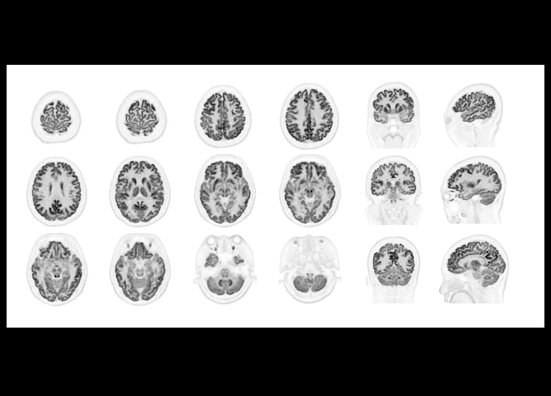 High Resolution Brain Imaging positioned at edge of AFOV