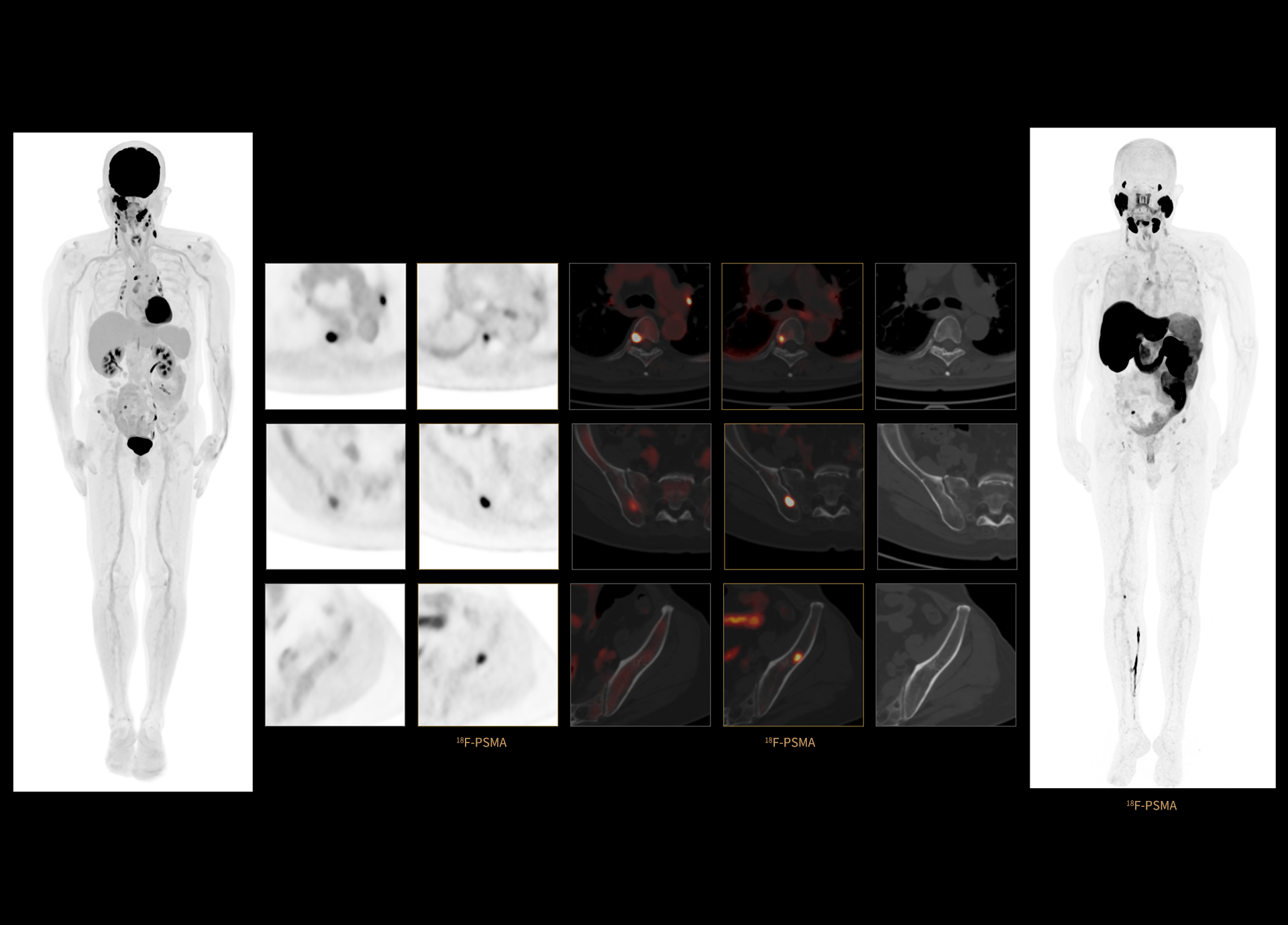 Dual-Tracer Scan of Patient with Multiple Myeloma