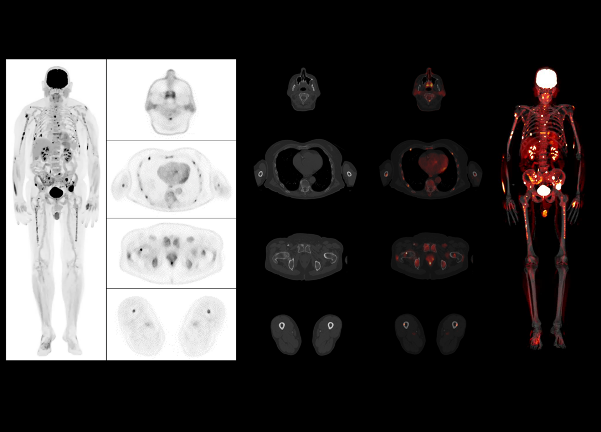 High Resolution PET/CT Imaging Enables Detecting Small Lesions