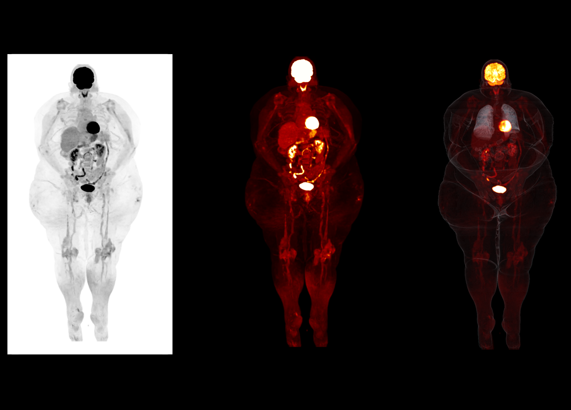 High Resolution PET/CT Imaging Enables Detecting Small Lesions