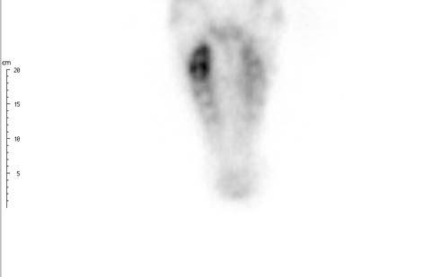 Dorsal View of the Head - scintigraphy