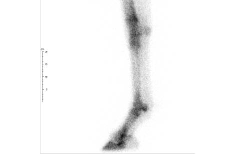 Lateral Bone Phase Image of the Distal LF - scintigraphy