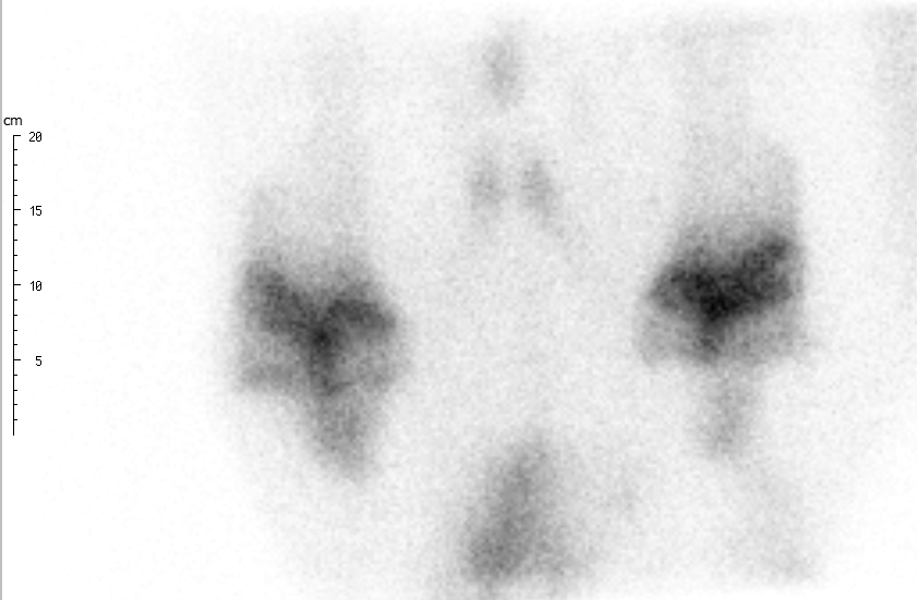 Screenshot Both shoulders - crop